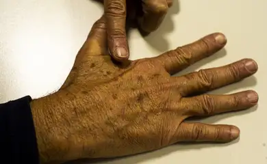 cancer_de_pele_melanoma20220520_0621