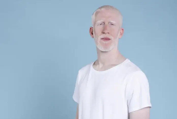 homem_albino